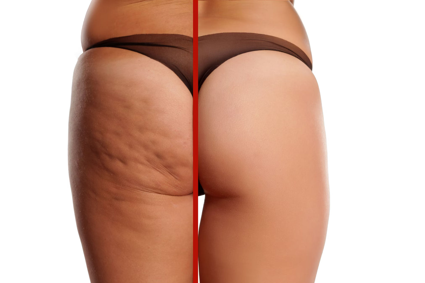 Anti-Cellulite Leg Sculptor