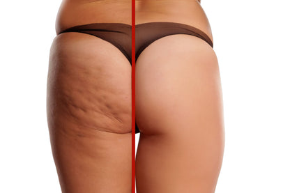 Anti-Cellulite Leg Sculptor