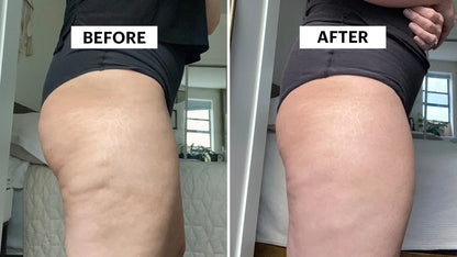 Anti-Cellulite Leg Sculptor